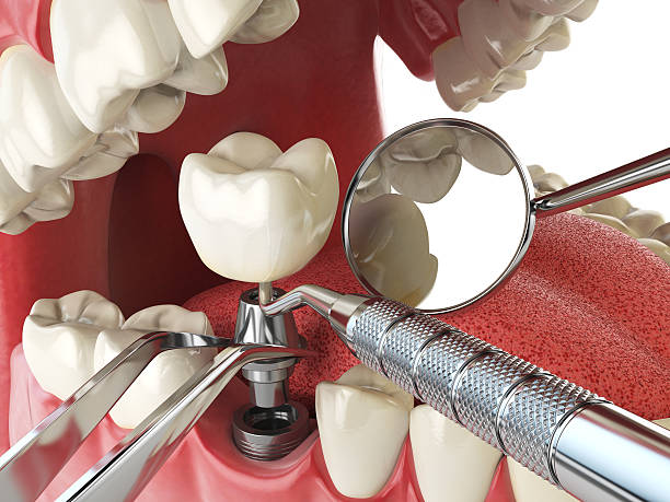 Best Emergency Tooth Extraction in Sebree, KY